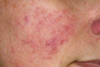 Rosacea