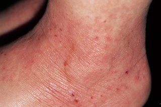 Eczema