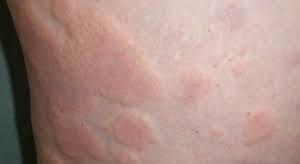 Urticaria