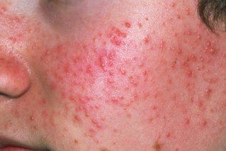 Acne