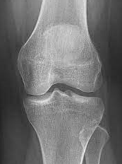 knee